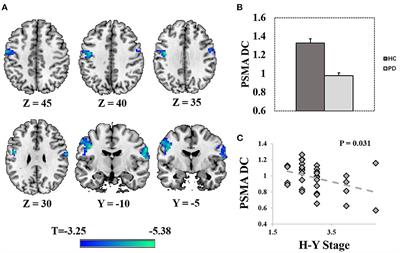 Severity-dependent functional connectome and the association with glucose metabolism in the sensorimotor cortex of Parkinson's disease